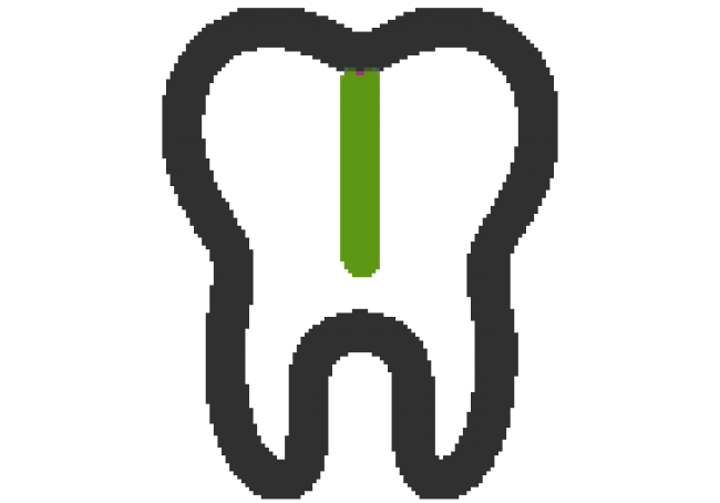 Kanal Tedavisi (Endodonti)